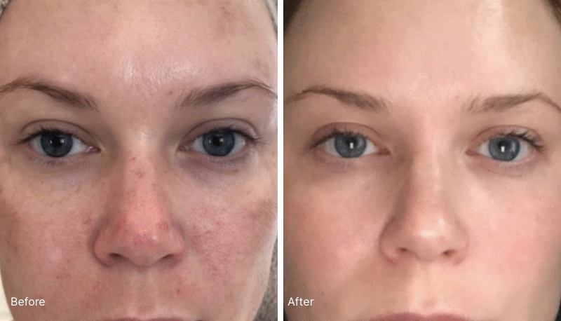 Before and After Images of woman’s face after using Neora skincare products