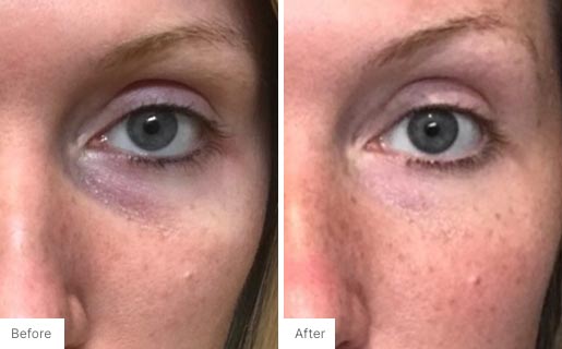 2 - Before and After Real Results photo of a woman's eye area.