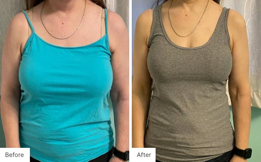 9 - Before and After of a woman's body using NeoraFit.